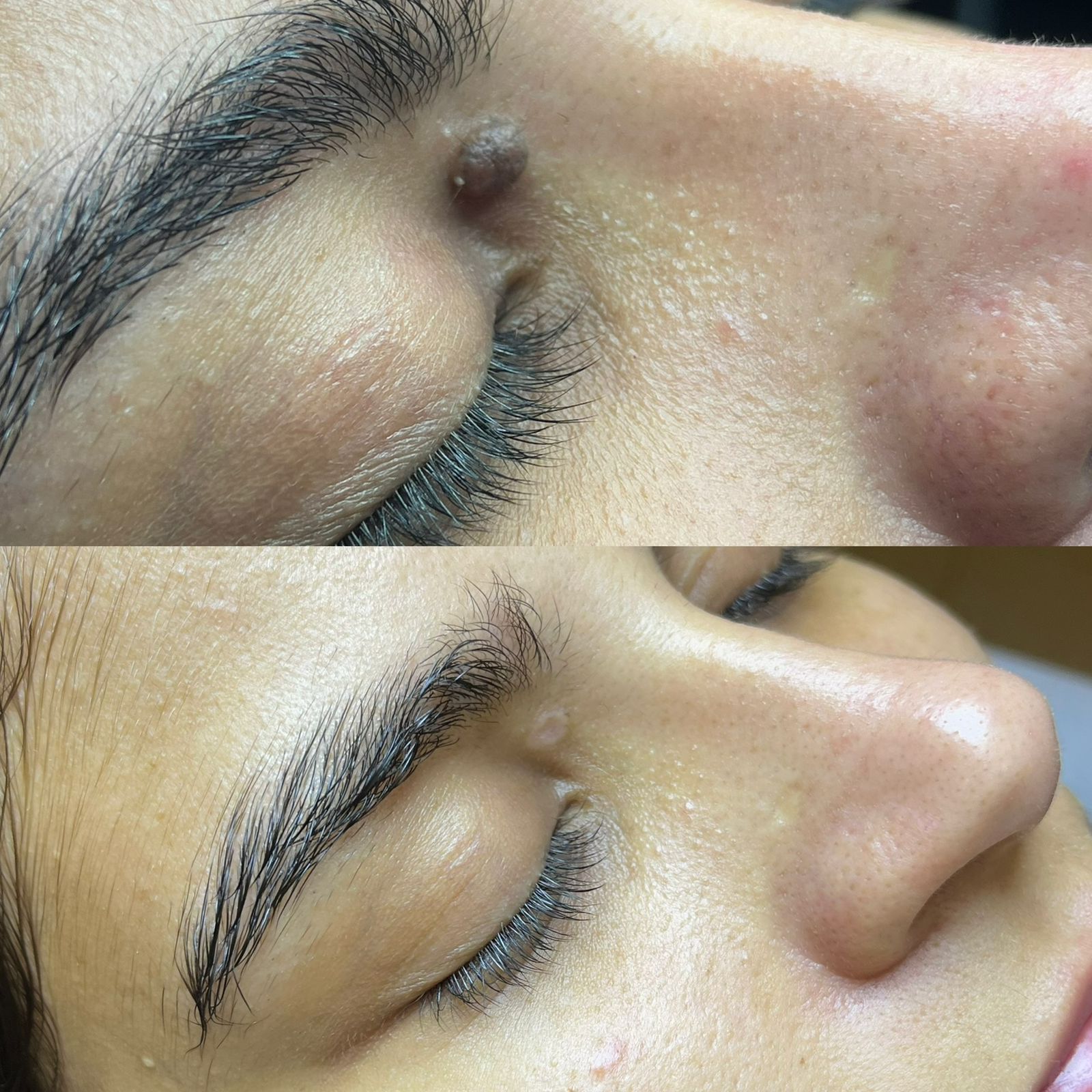Resultado de remoção de pinta na Divine Estetic