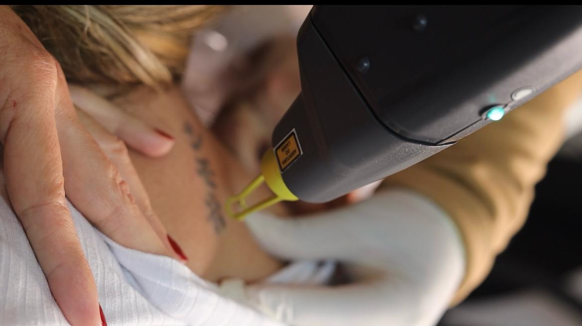 Remoção de Tatuagens