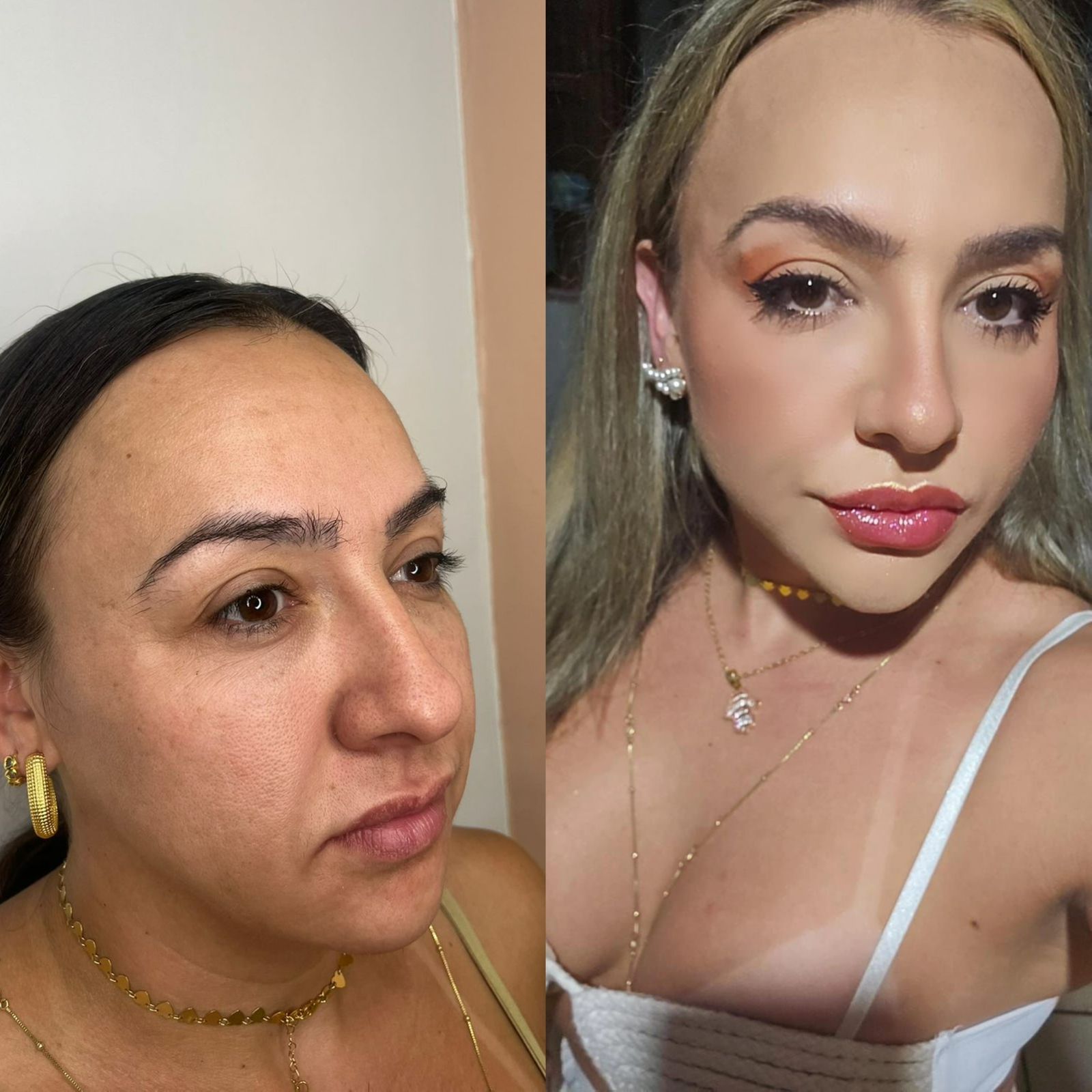 Harmonização Facial